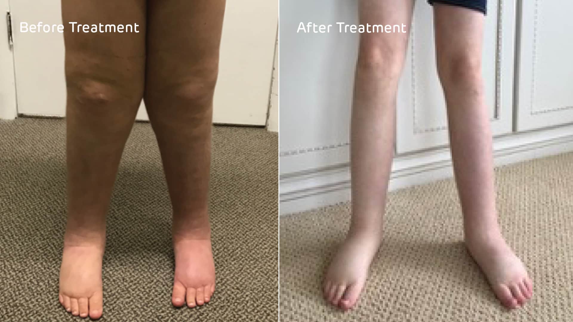 Swelling in legs - Before and after